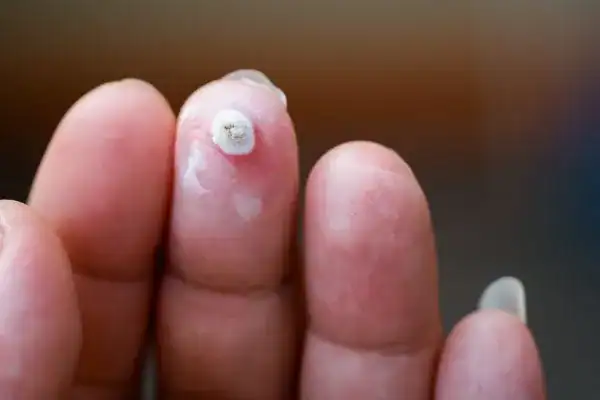 Image of white wart before cryopen treatment Haverhill