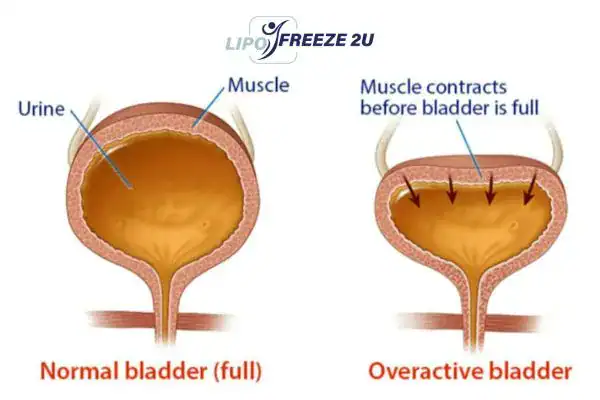 diagram of overactive bladder treatment Haverhill