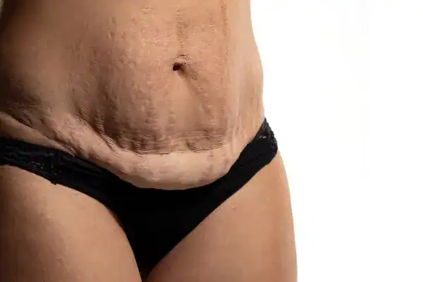 loose skin after weight loss injections Haverhill