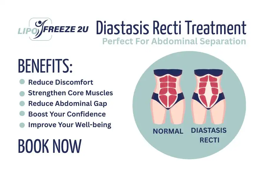 Benefits of body toning treatment Haverhill for Diastasis recti