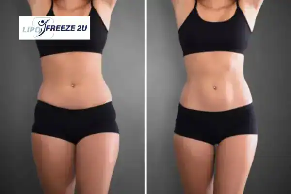 How Can LIPO FREEZE 2U Support Your Post-Pregnancy Body Recovery Haverhill?
