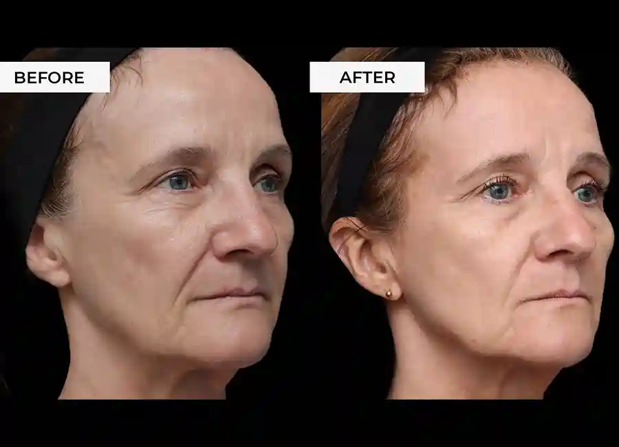 How Many RF Microneedling Sessions Will You Need to See a Difference Haverhill?
