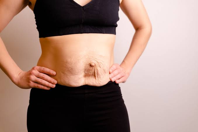 Is Surgery Really the Only Way to Repair Diastasis Recti Haverhill?