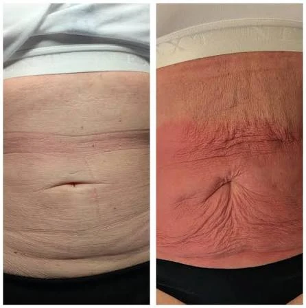 How Does RF Microneedling Improve Crepey, Thin and Uneven Skin Texture Haverhill?
