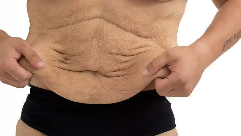 RF Microneedling for Loose Skin: How Can It Help Tighten and Reshape the Skin Haverhill?